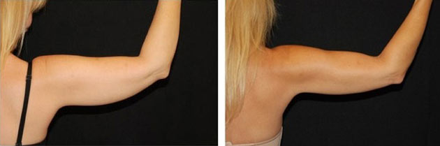 Laser Fat Removal Before & After